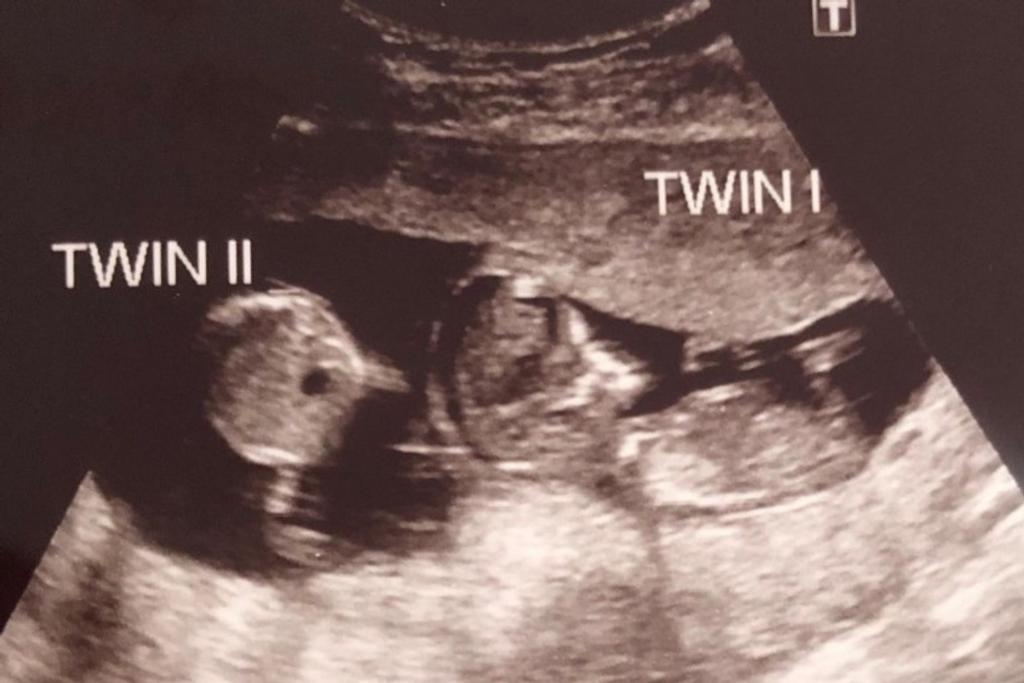 twins rare pregnancy inspiring